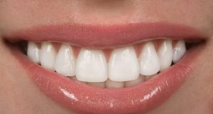 What You Must Know about Dental Veneers