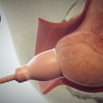 vacuum assisted birth is all about 1