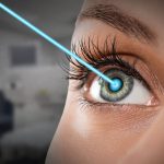 Laser Eye Surgery