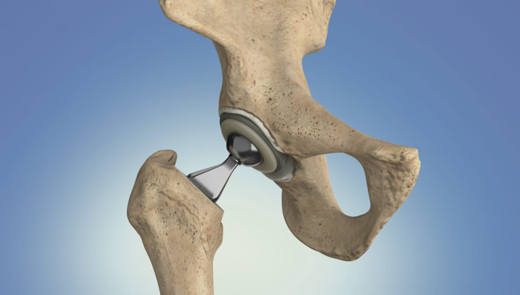 hip replacement surgery singapore