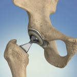 hip replacement surgery singapore