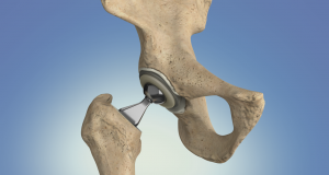 hip replacement surgery singapore