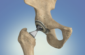 hip replacement surgery singapore
