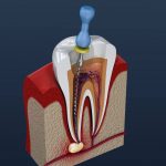 endodontic treatment