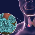 Thyroid Cancer2