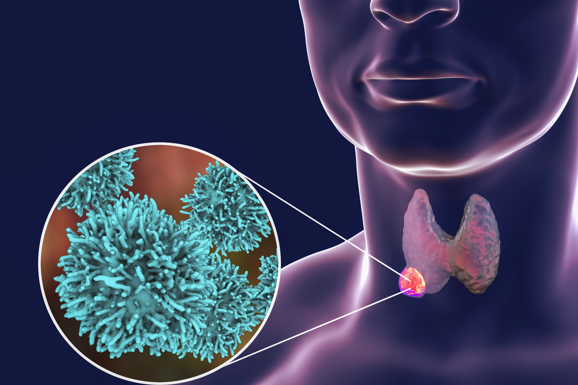 Thyroid Cancer2