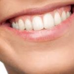 price of veneers