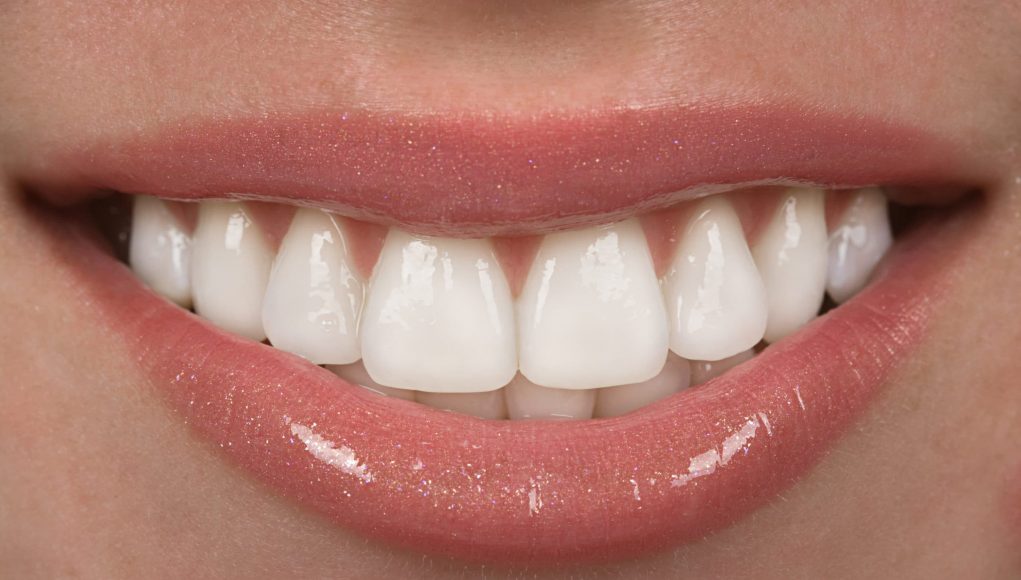 What You Must Know about Dental Veneers