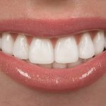 What You Must Know about Dental Veneers