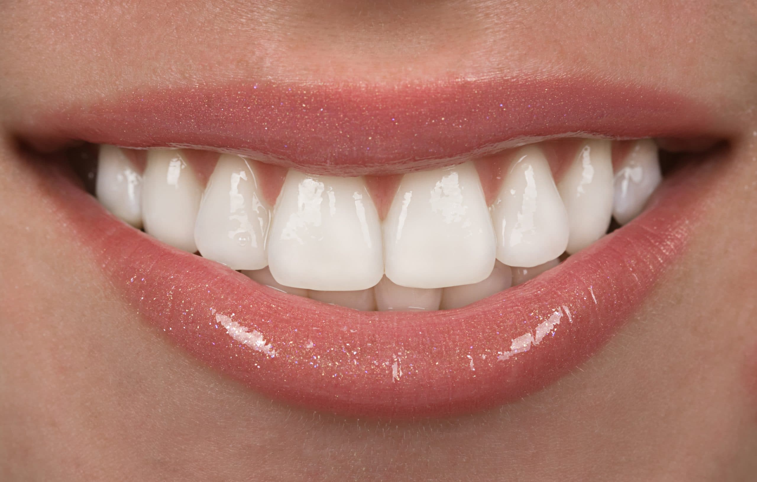 What You Must Know about Dental Veneers