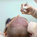 Learning The Best Hair Loss Treatment Review