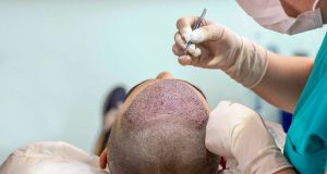 Learning The Best Hair Loss Treatment Review