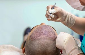 Learning The Best Hair Loss Treatment Review