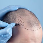 Looking for reviews for hair loss treatment in Singapore? Read this review by Two Herbs.