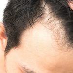 Hair Transplant