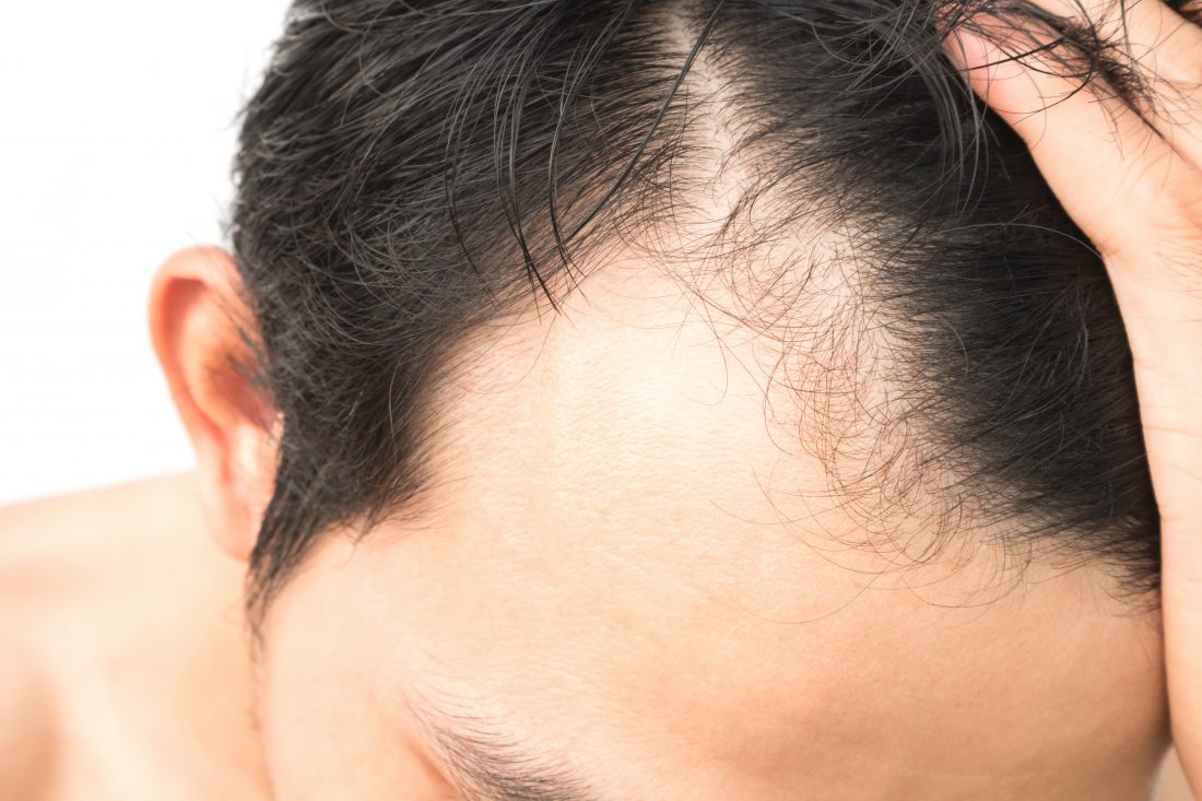 Hair Transplant