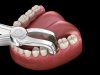 Get Acquainted With The Role And Responsibilities Of A Wisdom Tooth Removal Singapore