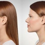 double chin removal