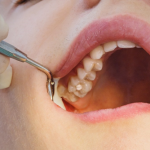 The Essential Reasons that Lead to Lost Dental Filling