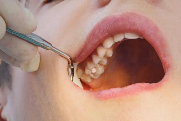 The Essential Reasons that Lead to Lost Dental Filling