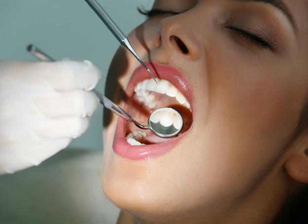 The Essential Reasons that Lead to Lost Dental Filling