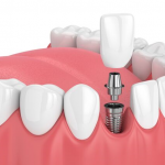 Long-term Care After Dental Implant 