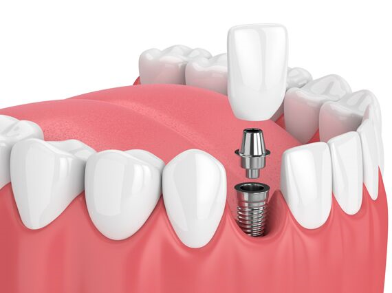 Long-term Care After Dental Implant 