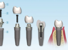 How to Care for Dental Implants after Surgery?