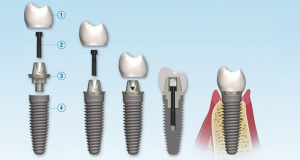 How to Care for Dental Implants after Surgery?