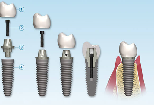 How to Care for Dental Implants after Surgery?