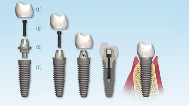 Long-term Care After Dental Implant 